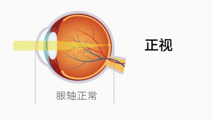 什么是远视储备？它和预防近视有什么关系？